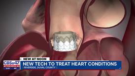 New technology is available at Ascension St. Vincent’s Riverside to treat AFib